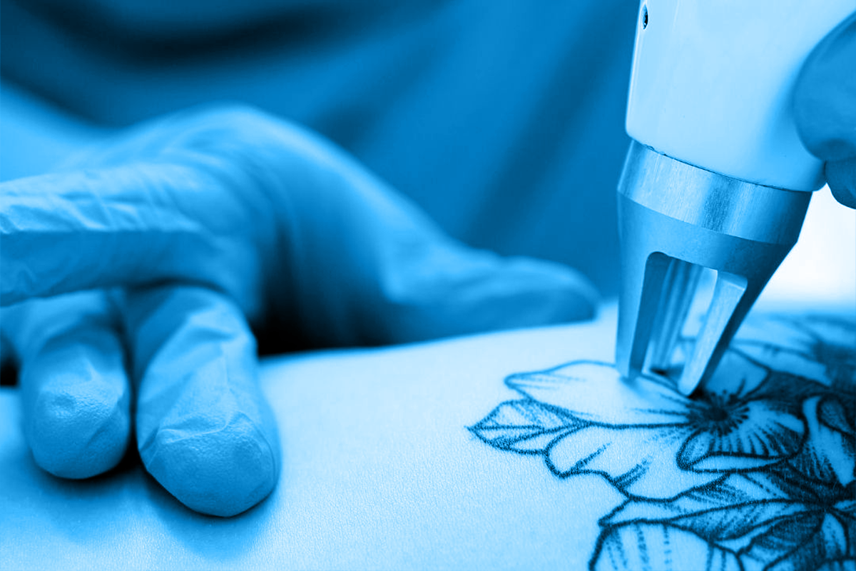 MMP Capital tattoo removal laser equipment financing
